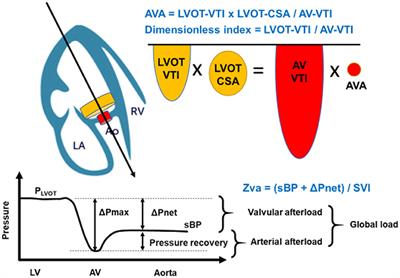 Valvulo-Arterial Impedance and Dimensionless Index for Risk Stratifying Patients With Severe Aortic Stenosis